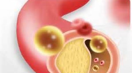 aterosclerosis-endurecimiento-arterias-Foto-Internet_NACIMA20140626_0010_6